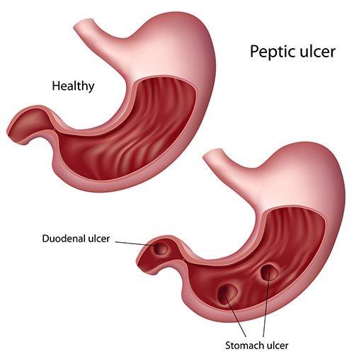 Ulkus Duodenum Gejala Penyebab Diagnosis Pengobatan