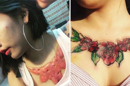 Dada Perempuan ini Mengerikan Usai Hilangkan Tato Pakai Teknik Ini