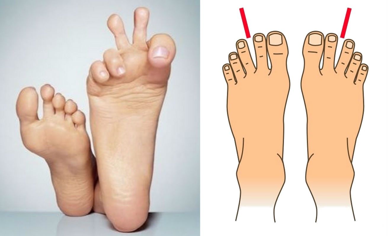 Какие бывают пальцы ног. Форма стопы. Форма пальцев на ногах. Типы форм пальцев на ногах.