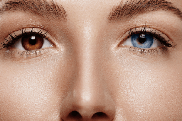 7 Fakta Heterochromia Orang yang Lahir dengan Warna Mata 