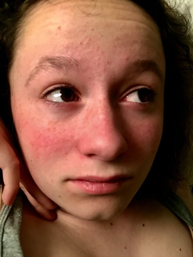 Kisah Martina Baker, Gadis Muda Asal AS yang Alergi Segala Macam Bau