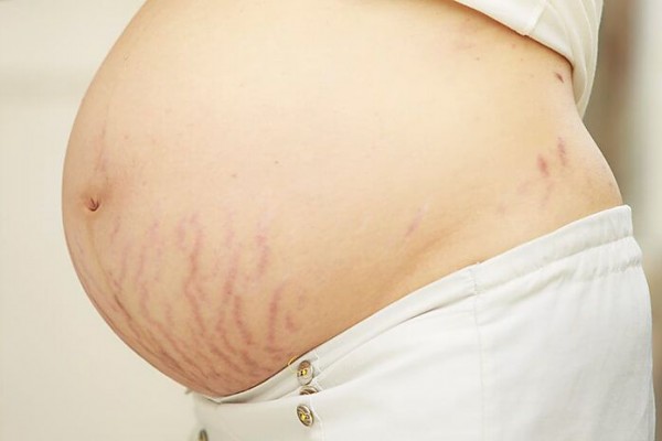 8 Cara Hilangkan Stretch Mark, Terapi Laser Hingga Coklat