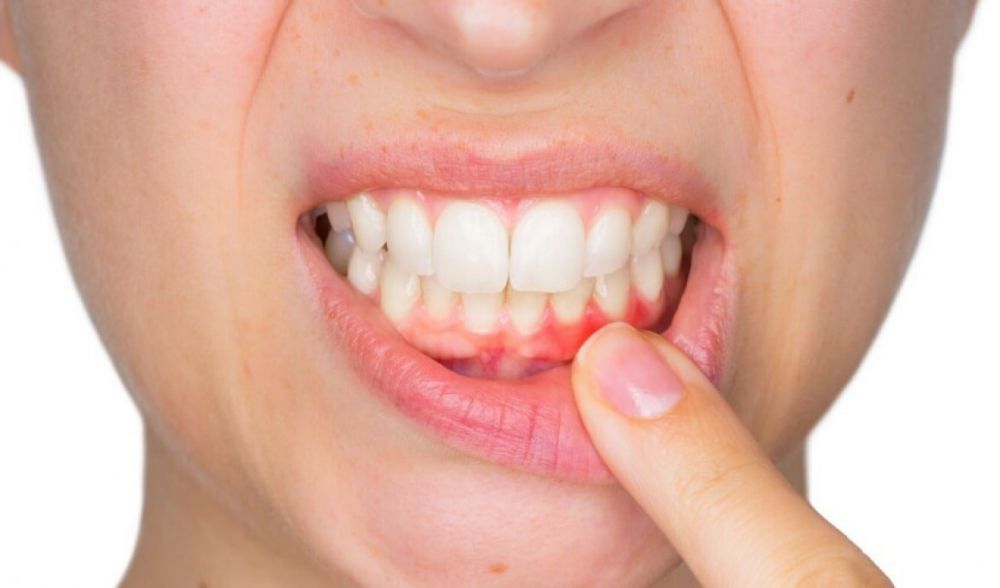 5 Risiko Buruk Kalau Kamu Malas Sikat Gigi Sebelum Tidur