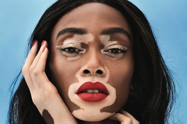 10 Fakta Vitiligo Kelainan Kulit Yang Dialami Model Winnie Harlow