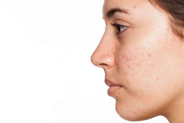 6 Tips Menghilangkan Bekas Jerawat dengan Bahan Alami