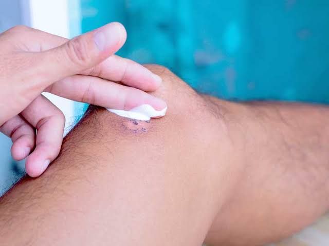 5 Fakta Seputar Keloid, Bekas Luka yang Bikin Gak Percaya Diri