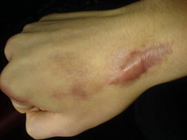 5 Fakta Seputar Keloid, Bekas Luka yang Bikin Gak Percaya Diri
