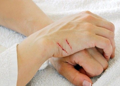 Cat Scratch Disease, Cakaran Kucing yang Berujung Jadi Penyakit!