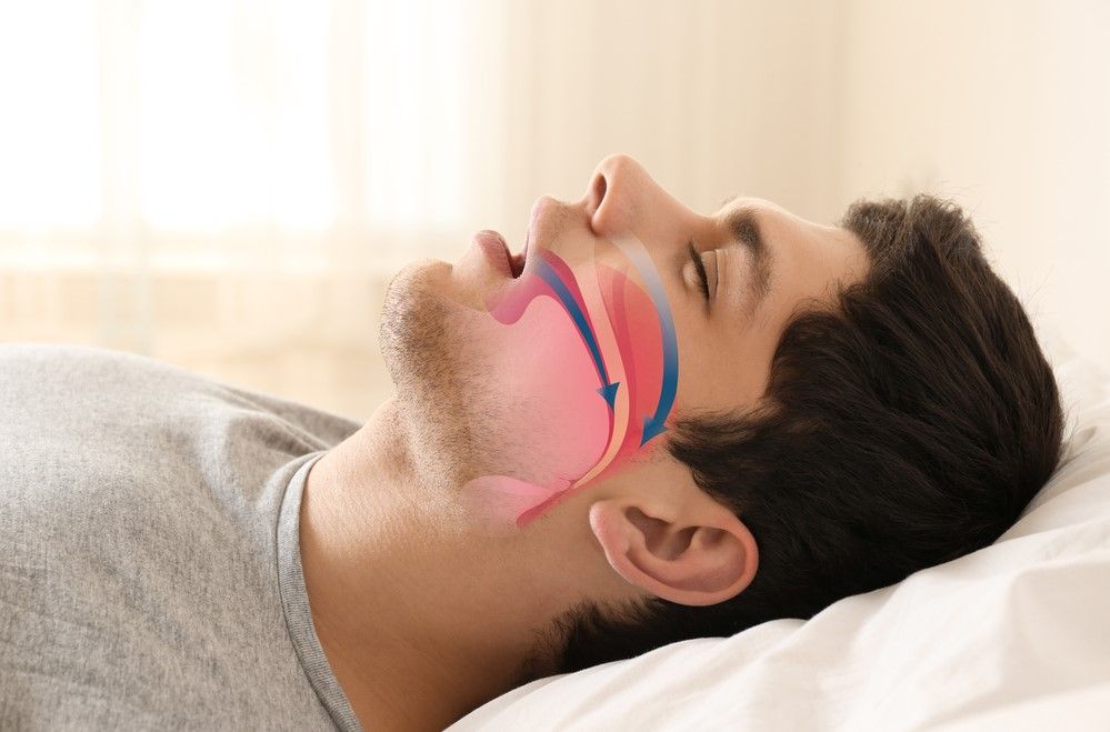 6 Fakta Penting Tentang Sleep Apnea Yang Wajib Kamu Ketahui 4900