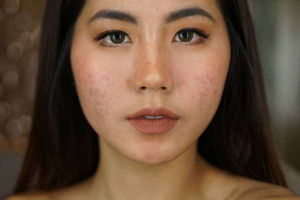 5 Acne Fighter Yang Menginspirasi Dan Sukses Menjadi Beauty Vlogger