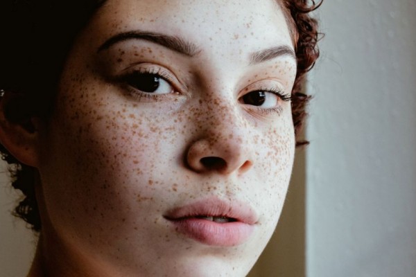 Skincare 101: Perbedaan Antara Tahi Lalat, Bintik, dan Tanda Lahir