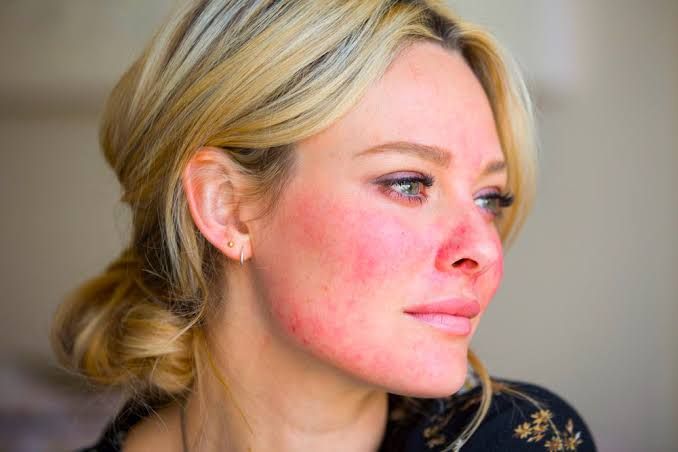 Skincare 101: Kenali Rosasea, Ruam Merah yang Sering Disangka Jerawat