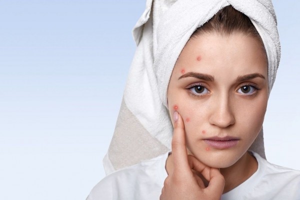 Acne Shaming Akibat Masalah Jerawat