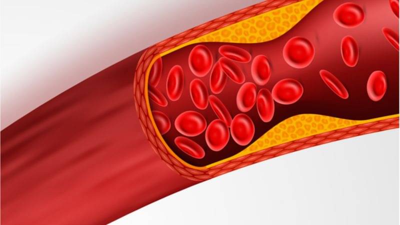 Cara Mencegah Penyakit Aterosklerosis – Sinau