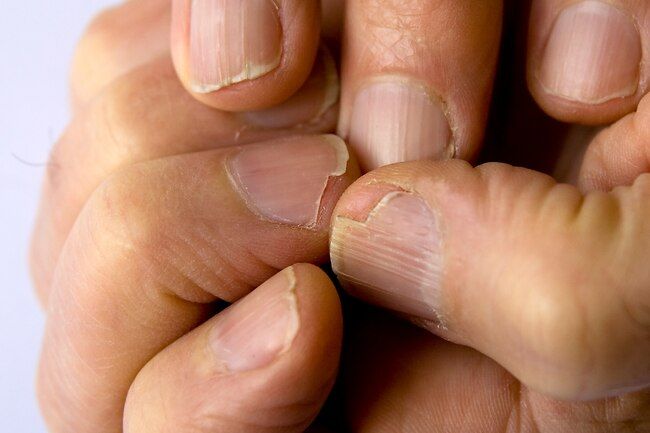 Brittle Nail Syndrome: Penyebab, Gejala, Pengobatan, dan Pencegahan