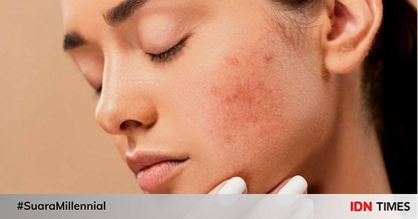 10 Produk Skincare Terbaik Untuk Acne Prone Skin, Ampuh Atasi Jerawat!