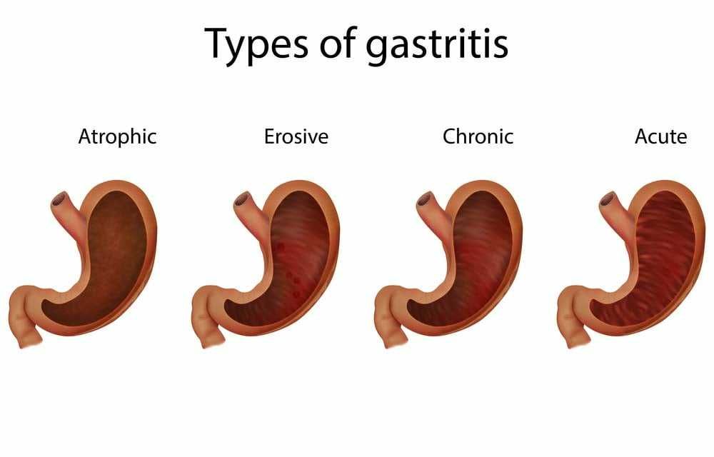 Gastritis Jenis Penyebab Gejala Diagnosis Pengobatan