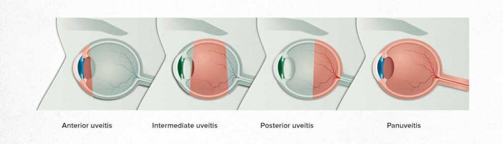 Uveitis: Penyebab, Jenis, Gejala, Komplikasi, Pengobatan