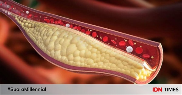 Penyebab, Bahaya, dan Cara Atasi Kolesterol Tinggi