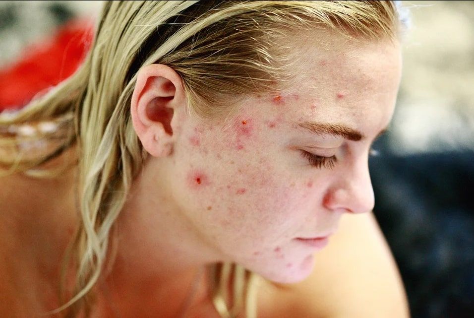 Bekas Jerawat Bopeng Bisa Sembuh Pakai Skincare? Ini Kata Dokter