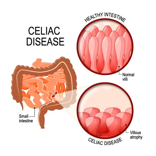 Penyakit Celiac, Penyakit Autoimun yang Dipicu Konsumsi Gluten