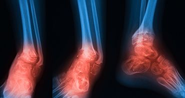 Bukan Cuma Osteoporosis, Ini 6 Penyakit Tulang yang Perlu Diwaspadai
