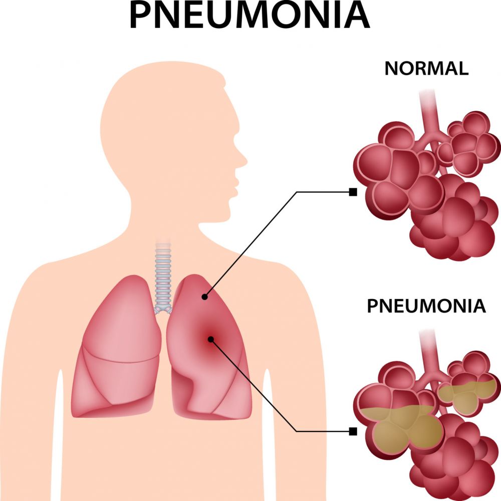 164 Kasus Pneumonia di Klungkung, Tidak Terkait Polusi Udara