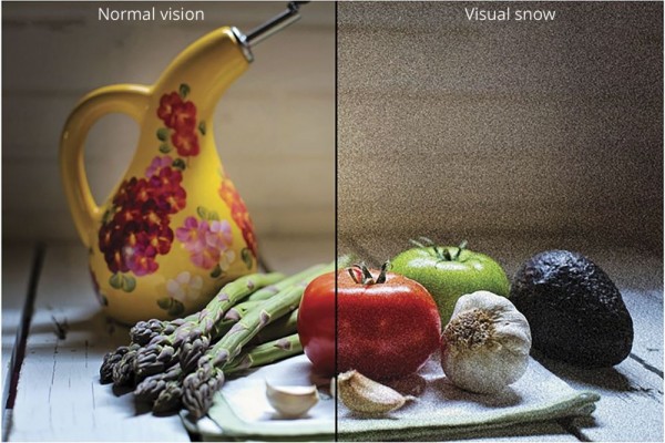 5 Fakta Sindrom Salju Visual, Penglihatan Berbintik mirip TV Analog
