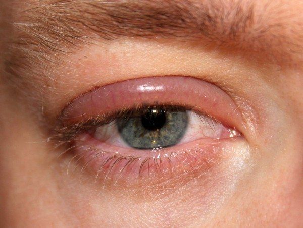 7 Penyebab Mata Terasa Sakit, Jangan Anggap Remeh