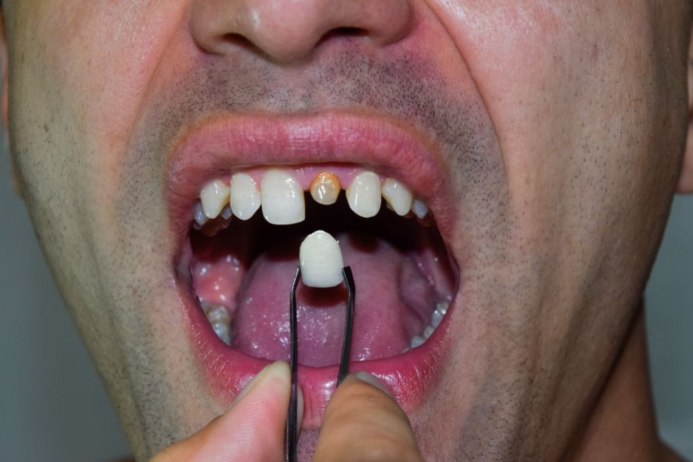 6 Mitos dan Fakta mengenai Veneer Gigi, Buat yang Masih Ragu!