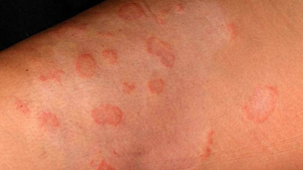 eczema i vene varicoase
