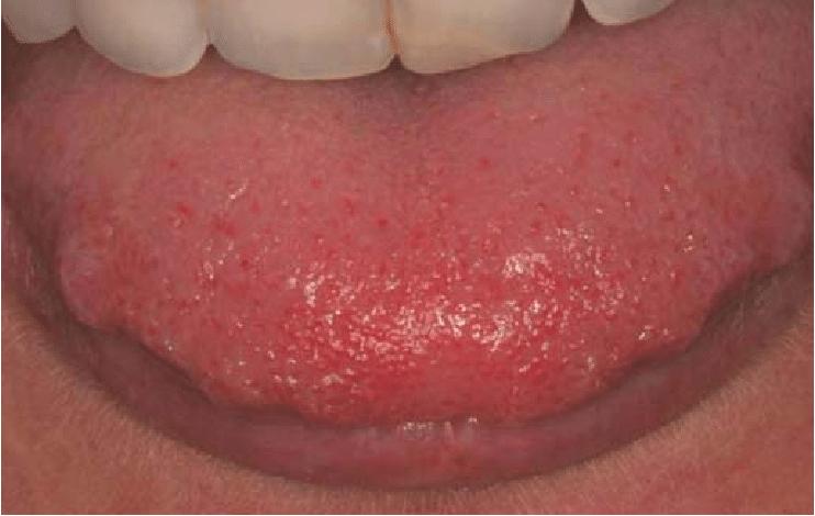 Penyebab dan Gejala Lidah Bergerigi (Scalloped Tongue)