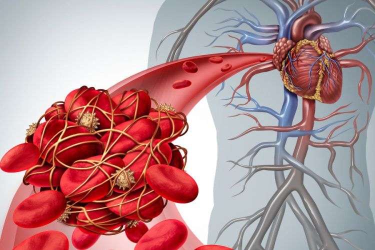 Venous Thromboembolism: Penyebab, Gejala, Dan Pengobatan