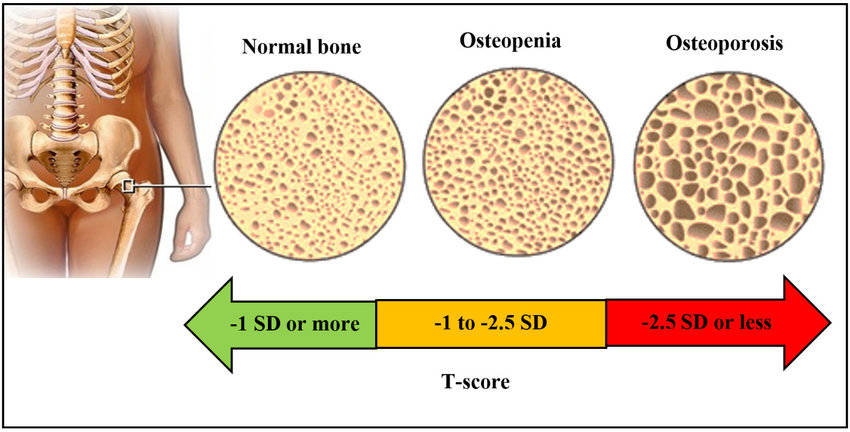 Osteopenia O Que Causas Diagn stico E Tratamentos WDGSG Osteopenia O Que Causas Diagn stico E Tratamentos WDGSG