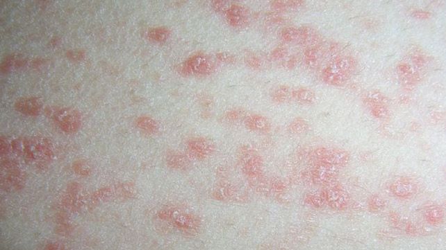 5 Jenis Psoriasis yang Mungkin Belum Kamu Ketahui