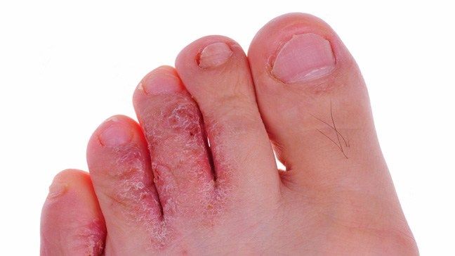 Sering Menyerang Kaki, Ini 5 Fakta tentang Kutu Air atau Tinea Pedis