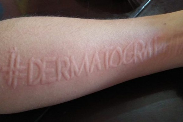Dermatographia: Gejala, Penyebab, dan Pengobatan
