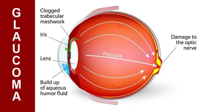 8 Jenis Glaukoma, Penyakit Yang Bisa Menyebabkan Kebutaan