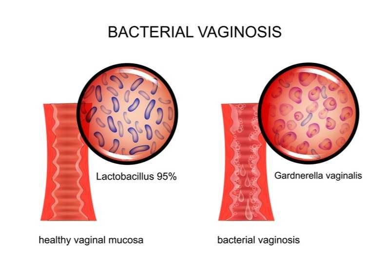 Penyebab Umum Keputihan Bau Amis, Kenali Vaginosis Bakterialis