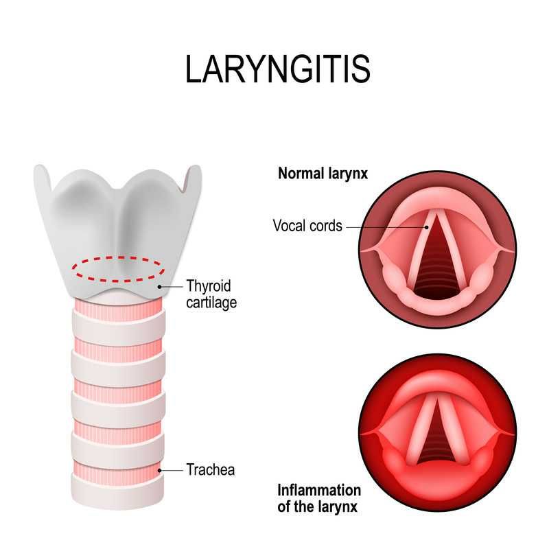 penyakit-laringitis-homecare24