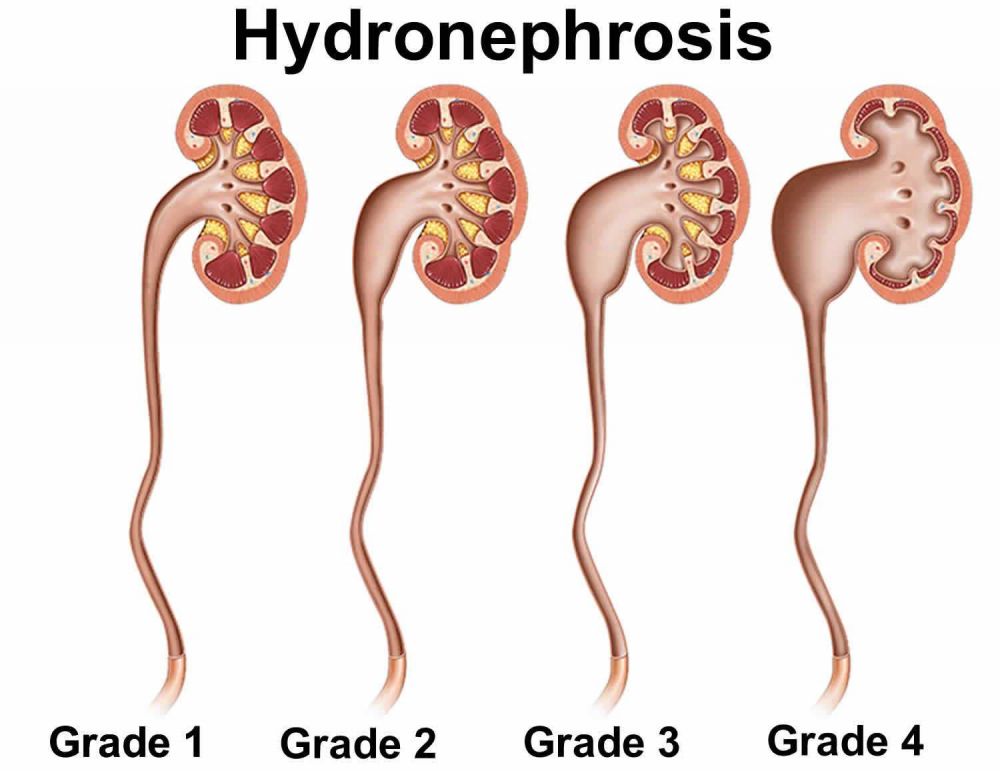 Kondisi Ginjal Bengkak akibat Penumpukan Urine, Kenali Hidronefrosis