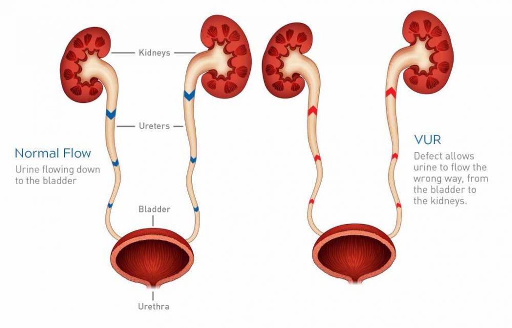 Kondisi Ginjal Bengkak akibat Penumpukan Urine, Kenali Hidronefrosis