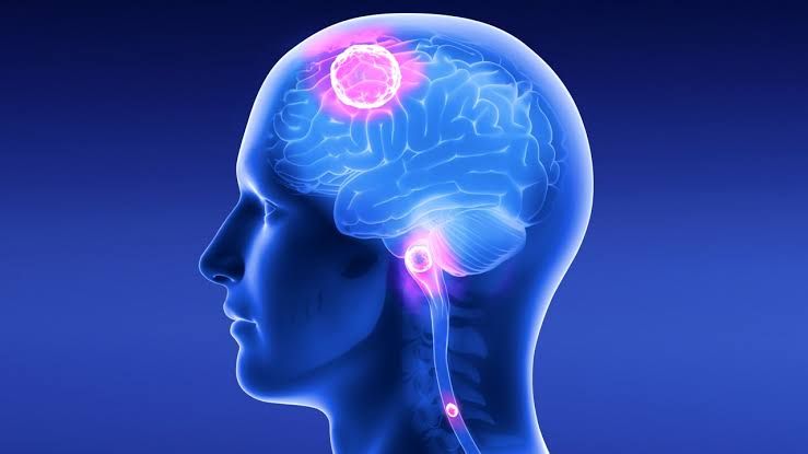 Dokter Bedah Syaraf Sebut Tumor Otak Tak Mengenal Usia 
