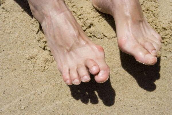 Sering Memakai Sepatu Kekecilan? Hati-Hati Alami Hammer Toe