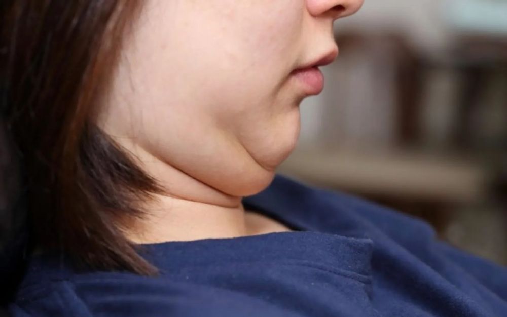 Jarang Diketahui, 5 Masalah Kesehatan Ini Menyebabkan Double Chin