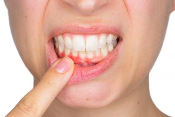 Gingivitis Radang Gusi Penyebab Gejala Dan Pengobatan