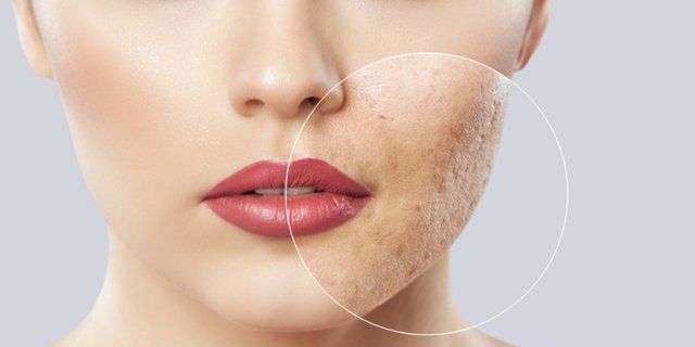 Bekas Jerawat Bopeng Bisa Sembuh Pakai Skincare? Ini Kata Dokter