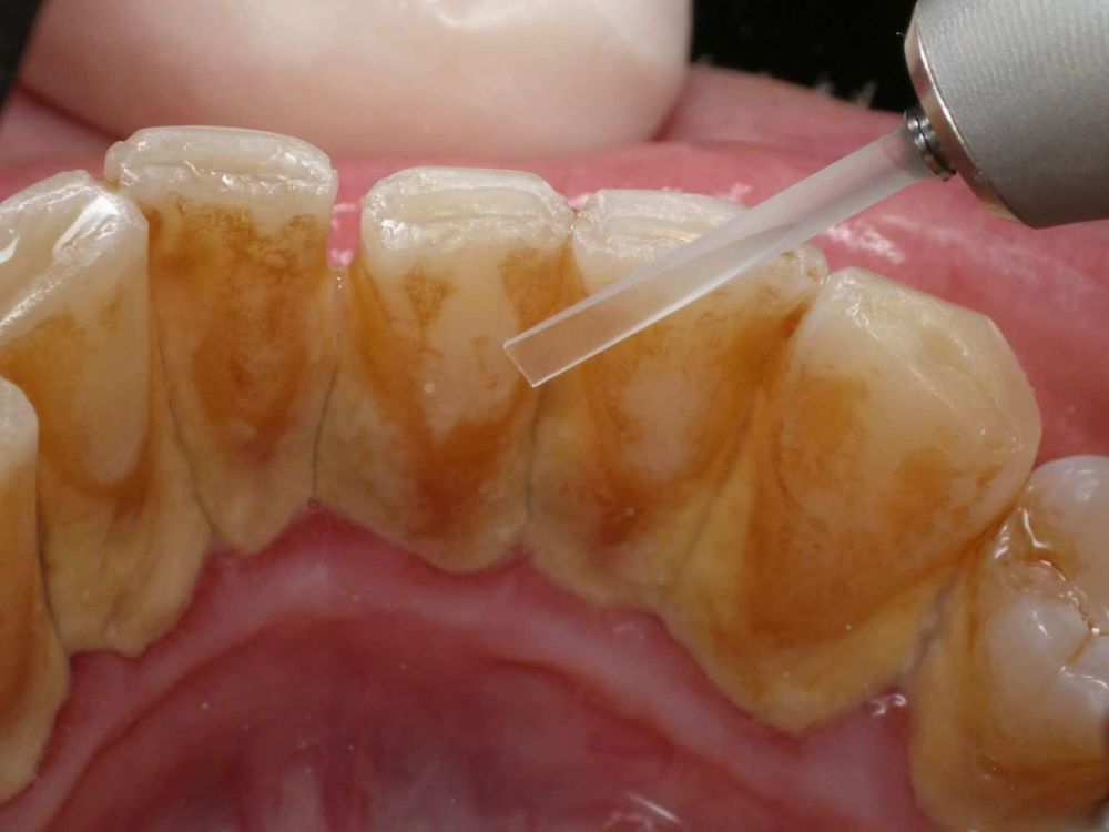 Apakah Karang Gigi ini Berbahaya 