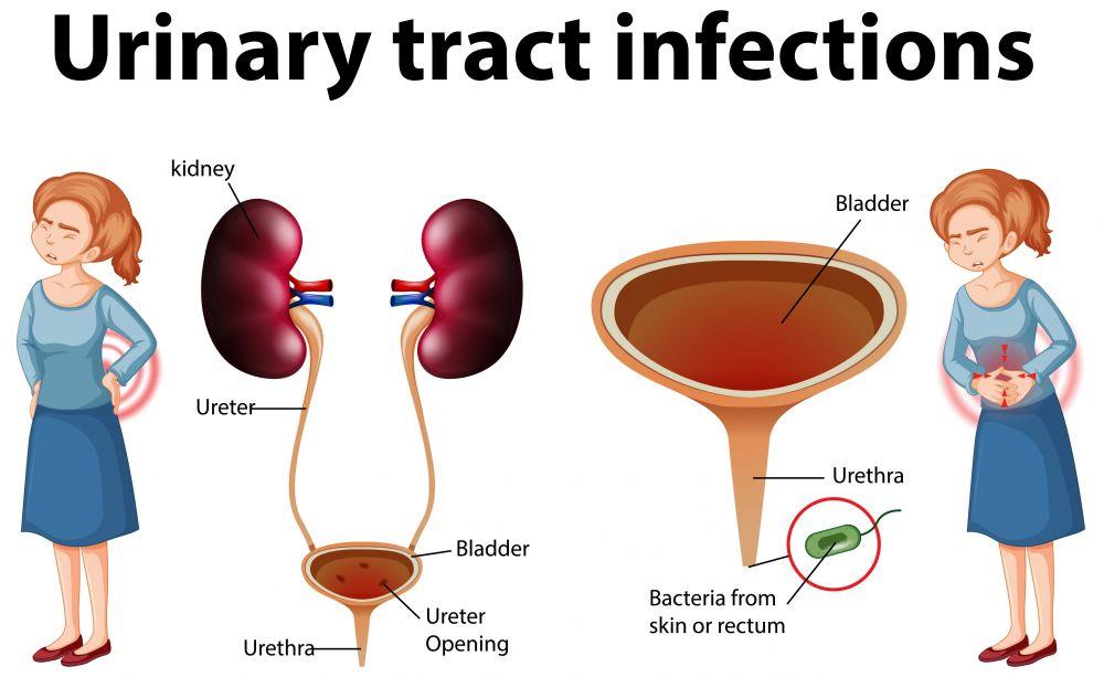 fakta-medis-uretritis-infeksi-peradangan-di-uretra