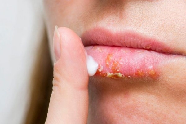 5 Penyebab Luka di Bibir, Mulai dari Alergi sampai Herpes